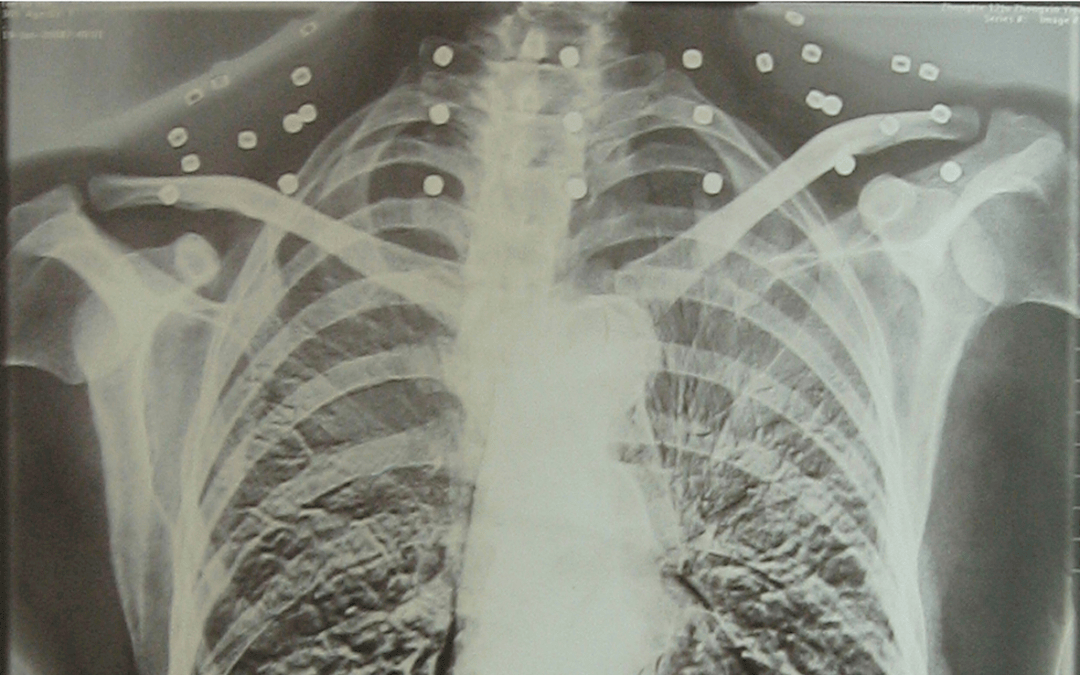 皇冠信用怎么弄
_“老先生皇冠信用怎么弄
，您把项链取下来再做CT”“你看是不是弹片”